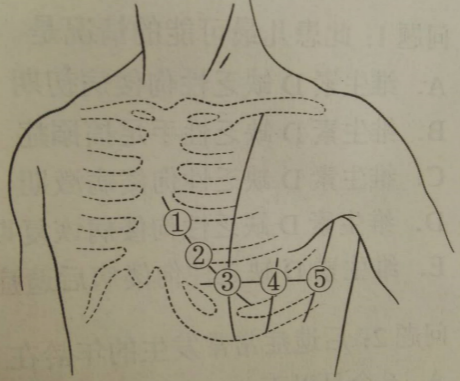 a1a2如图所示心电图检查时胸导联v5导联放置的位置是
